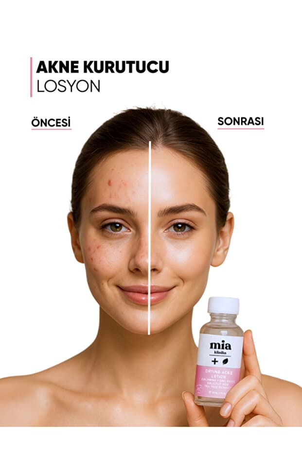 Akne Karşıtı Sivilce Kurutucu Losyon